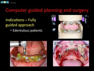Indica1ons	
  –	
  Fully	
  
guided	
  approach	
  
•  Edentulous	
  pa1ents	
  
	
  
Computer	
  guided	
  planning	
  and	
  surgery	
  
 