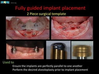  2	
  Piece	
  surgical	
  template	
  
Fully	
  guided	
  implant	
  placement	
  
Used	
  to	
  	
  
	
  Ensure	
  the	
  implants	
  are	
  perfectly	
  parallel	
  to	
  one	
  another	
  
	
  Perform	
  the	
  desired	
  alveoloplasty	
  prior	
  to	
  implant	
  placement	
  
 