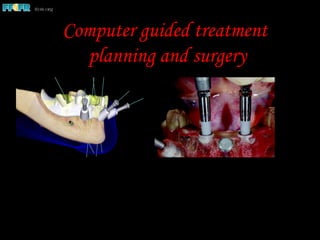 Computer guided treatment
planning and surgery
 