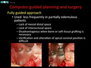 Fully	
  guided	
  approach	
  
•  Used	
  	
  less	
  frequently	
  in	
  par1ally	
  edentulous	
  
pa1ents	
  
– Lack	
  of	
  mesial	
  distal	
  space	
  
– Lack	
  of	
  interocclusal	
  space	
  
– Disadvantageous	
  when	
  bone	
  or	
  soC	
  1ssue	
  graCing	
  is	
  
necessary	
  
– Veriﬁca1on	
  and	
  altera1on	
  of	
  apical	
  coronal	
  posi1on	
  is	
  
diﬃcult	
  
	
  
Computer	
  guided	
  planning	
  and	
  surgery	
  
 