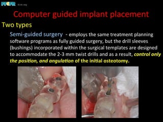 Two	
  types	
  
Semi-­‐guided	
  surgery	
  	
  -­‐	
  employs	
  the	
  same	
  treatment	
  planning	
  
soCware	
  programs	
  as	
  fully	
  guided	
  surgery,	
  but	
  the	
  drill	
  sleeves	
  
(bushings)	
  incorporated	
  within	
  the	
  surgical	
  templates	
  are	
  designed	
  
to	
  accommodate	
  the	
  2-­‐3	
  mm	
  twist	
  drills	
  and	
  as	
  a	
  result,	
  control	
  only	
  
the	
  posi.on,	
  and	
  angula.on	
  of	
  the	
  ini)al	
  osteotomy.	
  
Computer	
  guided	
  implant	
  placement	
  
 