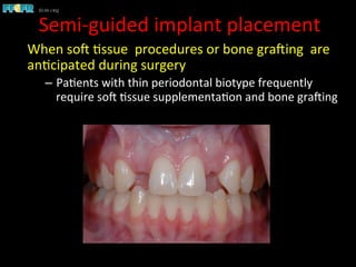 Semi-­‐guided	
  implant	
  placement	
  
When	
  soC	
  1ssue	
  	
  procedures	
  or	
  bone	
  graCing	
  	
  are	
  
an1cipated	
  during	
  surgery	
  
–  Pa1ents	
  with	
  thin	
  periodontal	
  biotype	
  frequently	
  
require	
  soC	
  1ssue	
  supplementa1on	
  and	
  bone	
  graCing	
  
 