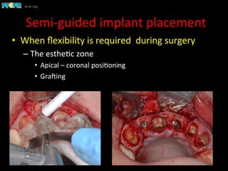 •  When	
  ﬂexibility	
  is	
  required	
  	
  during	
  surgery	
  
– The	
  esthe1c	
  zone	
  
•  Apical	
  –	
  coronal	
  posi1oning	
  
•  GraCing	
  
Semi-­‐guided	
  implant	
  placement	
  
 