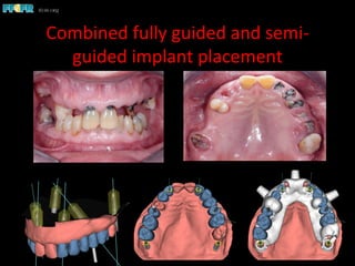 Combined	
  fully	
  guided	
  and	
  semi-­‐
guided	
  implant	
  placement	
  
 