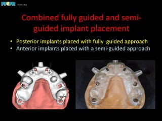 Combined	
  fully	
  guided	
  and	
  semi-­‐
guided	
  implant	
  placement	
  
•  Posterior	
  implants	
  placed	
  with	
  fully	
  	
  guided	
  approach	
  
•  Anterior	
  implants	
  placed	
  with	
  a	
  semi-­‐guided	
  approach	
  
 