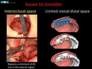 Issues	
  to	
  consider	
  
Interocclusal	
  space	
  	
  	
  	
  	
  	
  	
  	
  	
  	
  Limited	
  mesial	
  distal	
  space	
  
Requires	
  a	
  minimum	
  of	
  40	
  
mm	
  in	
  the	
  anterior	
  region	
  	
  
 