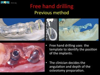 Free	
  hand	
  drilling	
  
Previous	
  method	
  
•  Free	
  hand	
  drilling	
  uses	
  	
  the	
  
template	
  to	
  iden1fy	
  the	
  posi1on	
  
of	
  the	
  implants.	
  	
  
•  The	
  clinician	
  decides	
  the	
  
angula1on	
  and	
  depth	
  of	
  the	
  
osteotomy	
  prepara1on.	
  
 