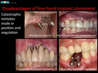 Disadvantages	
  of	
  free	
  hand	
  implant	
  placement	
  
Catastrophic	
  
mistakes	
  
made	
  in	
  
posi1on	
  and	
  
angula1on	
  
Labially	
  inclined	
  implants	
   Buccally	
  inclined	
  implants	
  
Implants	
  posi1oned	
  interproximally	
  Misaligned	
  implants	
  
 