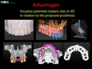 Advantages	
  
Visualize	
  poten1al	
  implant	
  sites	
  in	
  3D	
  
in	
  rela1on	
  to	
  the	
  proposed	
  prosthesis	
  
 