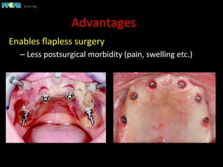 Advantages	
  
Enables	
  ﬂapless	
  surgery	
  
– Less	
  postsurgical	
  morbidity	
  (pain,	
  swelling	
  etc.)	
  
 