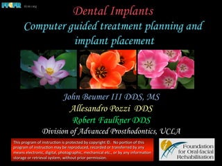 Dental Implants
Computer guided treatment planning and
implant placement
John Beumer III DDS, MS
Allesandro Pozzi DDS
Robert Faulkner DDS
Division of Advanced Prosthodontics, UCLA
This	
  program	
  of	
  instruc1on	
  is	
  protected	
  by	
  copyright	
  ©.	
  	
  No	
  por1on	
  of	
  this	
  
program	
  of	
  instruc1on	
  may	
  be	
  reproduced,	
  recorded	
  or	
  transferred	
  by	
  any	
  
means	
  electronic,	
  digital,	
  photographic,	
  mechanical	
  etc.,	
  or	
  by	
  any	
  informa1on	
  
storage	
  or	
  retrieval	
  system,	
  without	
  prior	
  permission.	
  
 
