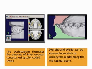 The Occlusogram illustrates
the amount of Inter occlusal
contacts using color coded
scales
Overbite and overjet can be
assessed accurately by
splitting the model along the
mid-sagittal plane.
 