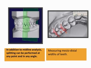 In addition to midline analysis,
splitting can be performed at
any point and in any angle.
Measuring mesio-distal
widths of teeth.
 