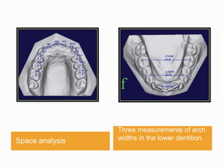 Space analysis
Three measurements of arch
widths in the lower dentition.
 