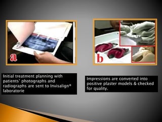 Initial treatment planning with
patients’ photographs and
radiographs are sent to Invisalign®
laboratorie
Impressions are converted into
positive plaster models & checked
for quality.
 