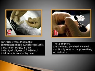 For each stereolithographic
constructed model (which represents
a treatment stage), a clear
Invisalign® aligner of 0.030 inch
thickness, is created by heat
These aligners
are trimmed, polished, cleaned
and finally sent to the prescribing
orthodontist.
 