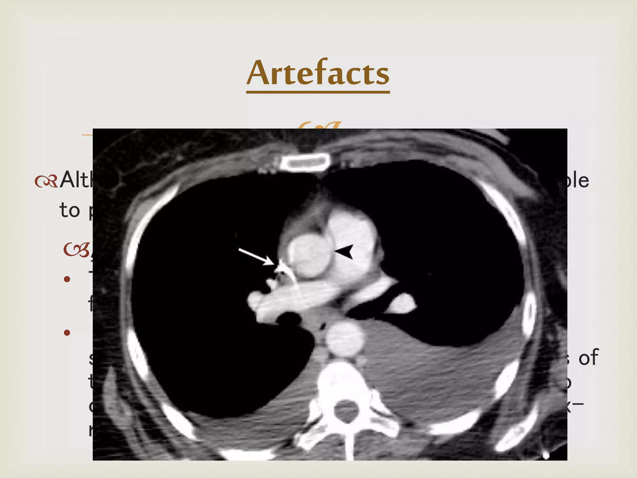 
Although CT is a relatively accurate test, it is liable
to produce artifacts, such as the following:
Aliasing Artifact or Streaks
• These appear as dark lines which radiate away
from sharp corners.
• It occurs because it is impossible for the
scanner to 'sample' or take enough projections of
the object, which is usually metallic. It can also
occur when an insufficient penetration of the x-
ray occurs.
Artefacts
 