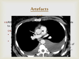 
Although CT is a relatively accurate test, it is liable
to produce artifacts, such as the following:
Aliasing Artifact or Streaks
• These appear as dark lines which radiate away
from sharp corners.
• It occurs because it is impossible for the
scanner to 'sample' or take enough projections of
the object, which is usually metallic. It can also
occur when an insufficient penetration of the x-
ray occurs.
Artefacts
 
