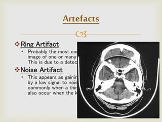 
Ring Artifact
• Probably the most common mechanical artifact, the
image of one or many 'rings' appears within an image.
This is due to a detector fault.
Noise Artifact
• This appears as gaining on the image and is caused
by a low signal to noise ratio. This occurs more
commonly when a thin slice thickness is used. It can
also occur when the kV or mA is too low.
Artefacts
 