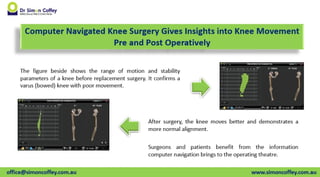Computer Navigated Knee Surgery Gives