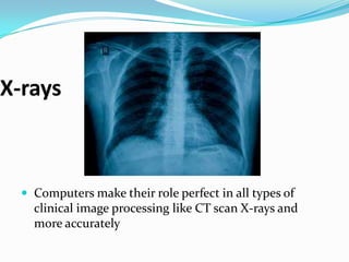 X-rays



   Computers make their role perfect in all types of
    clinical image processing like CT scan X-rays and
    more accurately
 