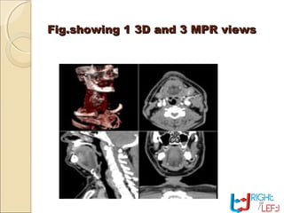 Fig.showing 1 3D and 3 MPR viewsFig.showing 1 3D and 3 MPR views
 