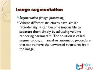 Image segmentationImage segmentation
Segmentation (image processing)
Where different structures have similar
radiodensity, it can become impossible to
separate them simply by adjusting volume
rendering parameters. The solution is called
segmentation, a manual or automatic procedure
that can remove the unwanted structures from
the image.
 