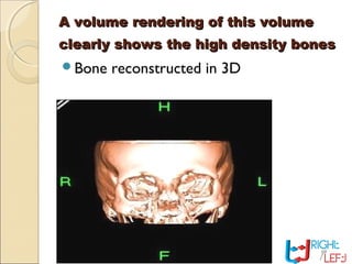 A volume rendering of this volumeA volume rendering of this volume
clearly shows the high density bonesclearly shows the high density bones
Bone reconstructed in 3D
 
