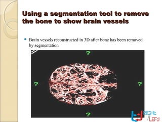 Using a segmentation tool to removeUsing a segmentation tool to remove
the bone to show brain vesselsthe bone to show brain vessels
 Brain vessels reconstructed in 3D after bone has been removed
by segmentation
 