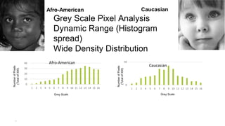 24
Afro-American Caucasian
Grey Scale Pixel Analysis
Dynamic Range (Histogram
spread)
Wide Density Distribution
0
50
1 2 3 4 5 6 7 8 9 10 11 12 13 14 15 16
Caucasian
0
10
20
30
40
1 2 3 4 5 6 7 8 9 10 11 12 13 14 15 16
Afro-American
Grey Scale Grey Scale
Number
of
Pixels
(Total
of
300)
Number
of
Pixels
(Total
of
300)
 