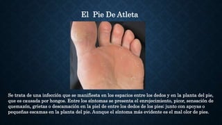 Se trata de una infección que se manifiesta en los espacios entre los dedos y en la planta del pie,
que es causada por hongos. Entre los síntomas se presenta el enrojecimiento, picor, sensación de
quemazón, grietas o descamación en la piel de entre los dedos de los pies; junto con apoyas o
pequeñas escamas en la planta del pie. Aunque el síntoma más evidente es el mal olor de pies.
El Pie De Atleta
 