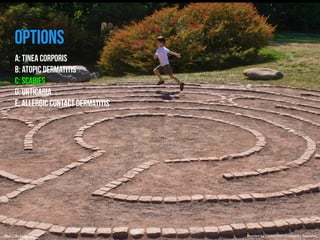 OPTIONS 
A: TINEA CORPORIS 
B: ATOPIC DERMATITIS 
C: SCABIES 
D: URTICARIA 
E: ALLERGIC CONTACT DERMATITIS 
https://flic.kr/p/5fddH1 Provided by COMQUEST Osteopathic Specialists. 
 