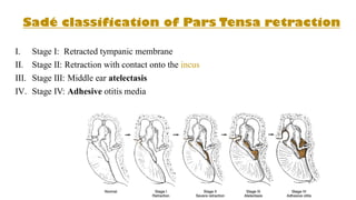 Sadé classification of Pars Tensa retraction
I. Stage I: Retracted tympanic membrane
II. Stage II: Retraction with contact onto the incus
III. Stage III: Middle ear atelectasis
IV. Stage IV: Adhesive otitis media
 