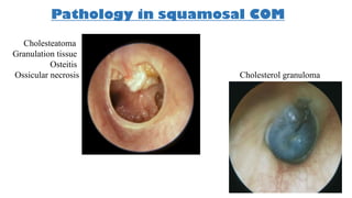Pathology in squamosal COM
Cholesteatoma
Granulation tissue
Osteitis
Ossicular necrosis Cholesterol granuloma
 