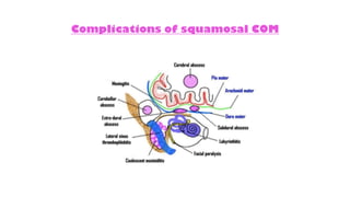 Complications of squamosal COM
 