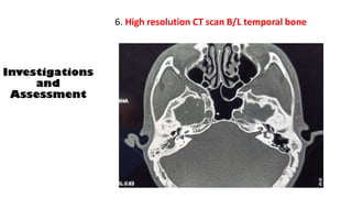 6. High resolution CT scan B/L temporal bone
Investigations
and
Assessment
 