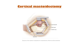 Cortical mastoidectomy
Exposure of the mastoid in preparation for mastoidectomy. Note the surface landmarks
 