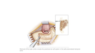 Removal of the outer cortex reveals the peripheral air cell system in the well pneumatized temporal
bone
 