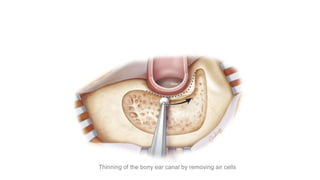 Thinning of the bony ear canal by removing air cells
 