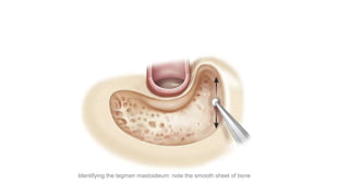 Identifying the tegmen mastoideum: note the smooth sheet of bone
 