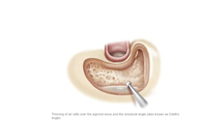 Thinning of air cells over the sigmoid sinus and the sinodural angle (also known as Citelli’s
angle)
 