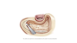 Tip cells are opened as necessitated by the extent of pneumatization
 
