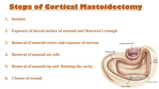 Steps of Cortical Mastoidectomy
1. Incision
2. Exposure of lateral surface of mastoid and Macewen’s triangle
3. Removal of mastoid cortex and exposure of antrum
4. Removal of mastoid air cells
5. Removal of mastoid tip and finishing the cavity
6. Closure of wound
Sinodural angle
Posterior wall of EAC
Sinus Plate
Dural
plate
 