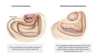 Cortical Mastoidectomy Modified Radical Mastoidectomy
It is an exenteration of all accessible mastoid air
cells preserving the posterior meatal wall
It is an operation to eradicate disease of the attic and
mastoid, both of which are exteriorized into the
external auditory canal by removal of the posterior
meatal and lateral attic walls
 