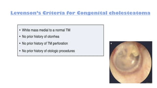 Levenson’s Criteria for Congenital cholesteatoma
 