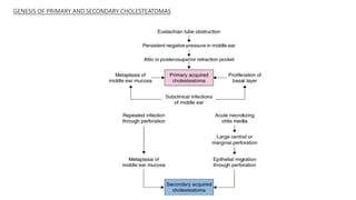 GENESIS OF PRIMARY AND SECONDARY CHOLESTEATOMAS
 