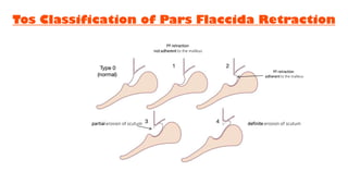 Tos Classification of Pars Flaccida Retraction
partial erosion of scutum definite erosion of scutum
PF retraction
not adherent to the malleus
PF retraction
adherent to the malleus
 