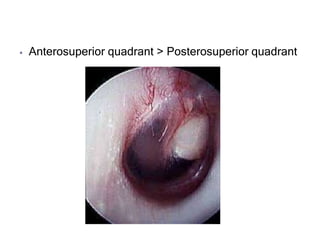 ⦁ Anterosuperior quadrant > Posterosuperior quadrant
 