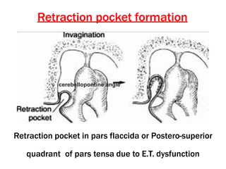 Retraction pocket formation
Retraction pocket in pars flaccida or Postero-superior
quadrant of pars tensa due to E.T. dysfunction
cerebellopontine angle
 