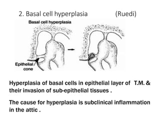 2. Basal cell hyperplasia (Ruedi)
Hyperplasia of basal cells in epithelial layer of T.M. &
their invasion of sub-epithelial tissues .
The cause for hyperplasia is subclinical inflammation
in the attic .
 